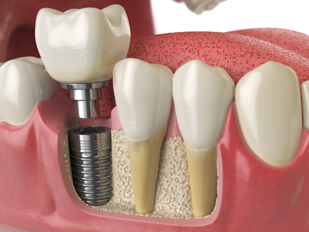 Anatomy of healthy teeth and tooth dental implant in dentura.