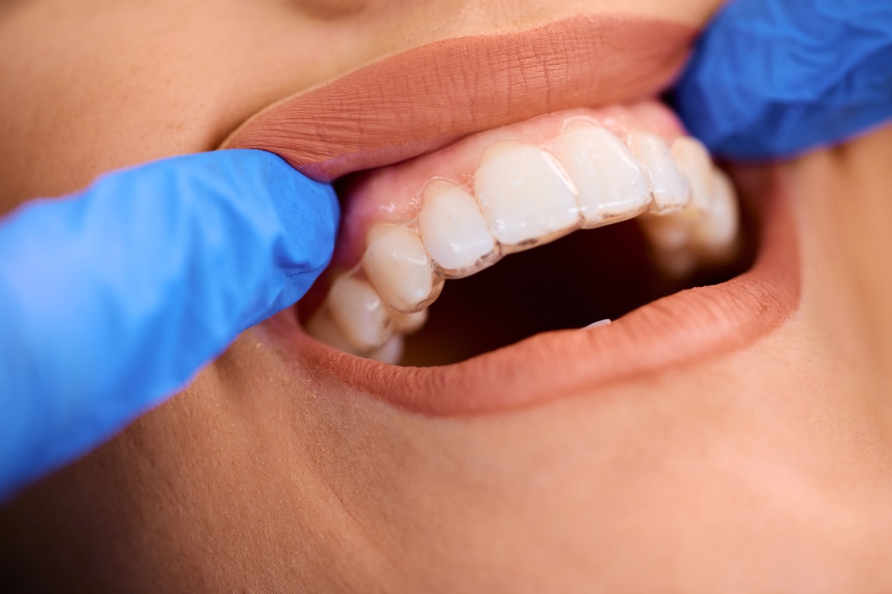 Close up of woman getting dental Invisalign on her teeth at dentist's.