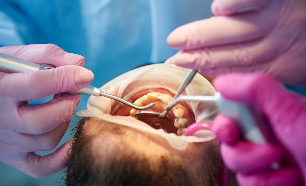 Closeup of a scaling and polishing procedure performed by two dentists in pink gloves to a male client.