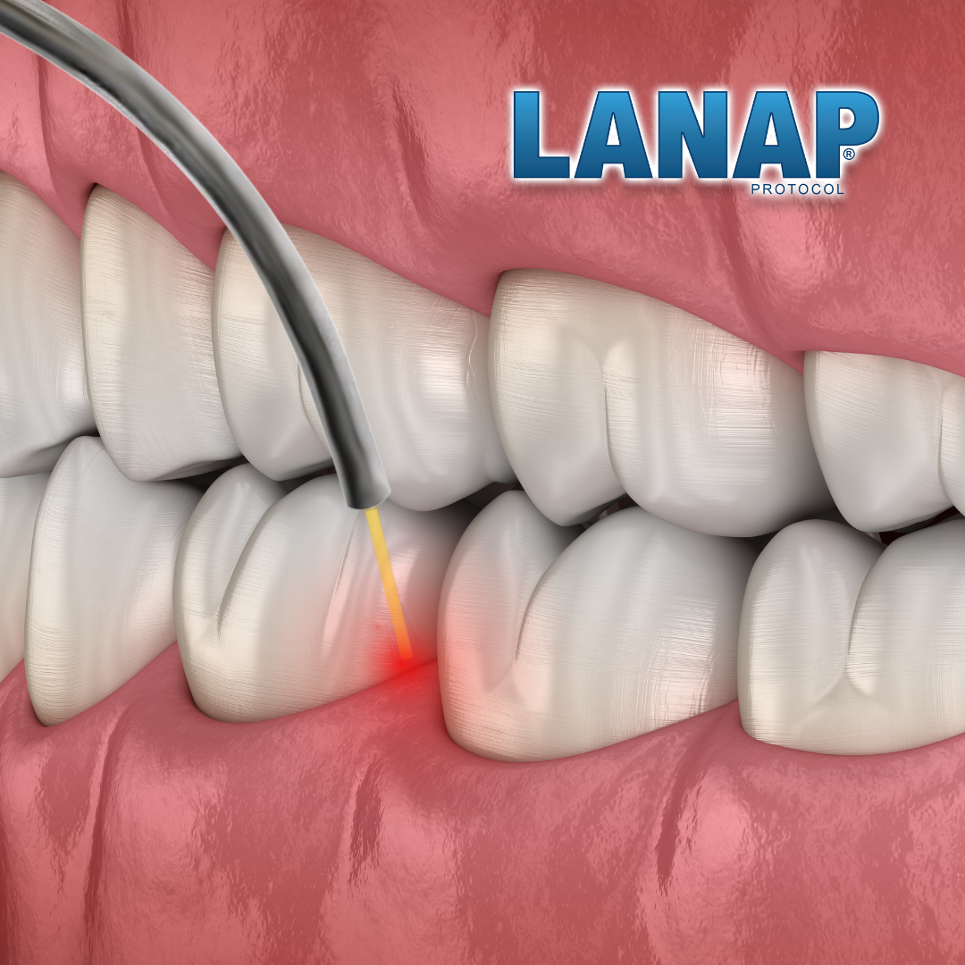 LANAP Laser Non-Surgical Treatment for Gum Disease
